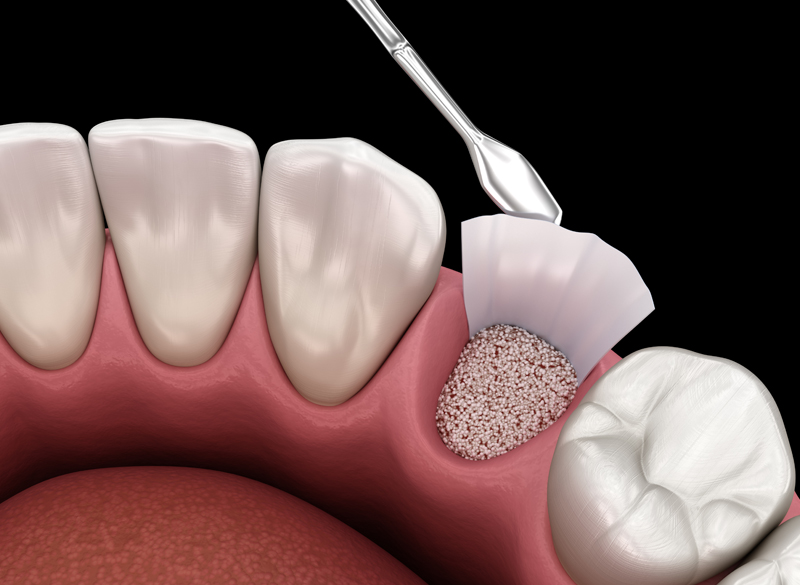 カムログ社製のインプラントを採用し、骨造成にも対応